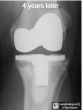 Loose Knee Prosthesis